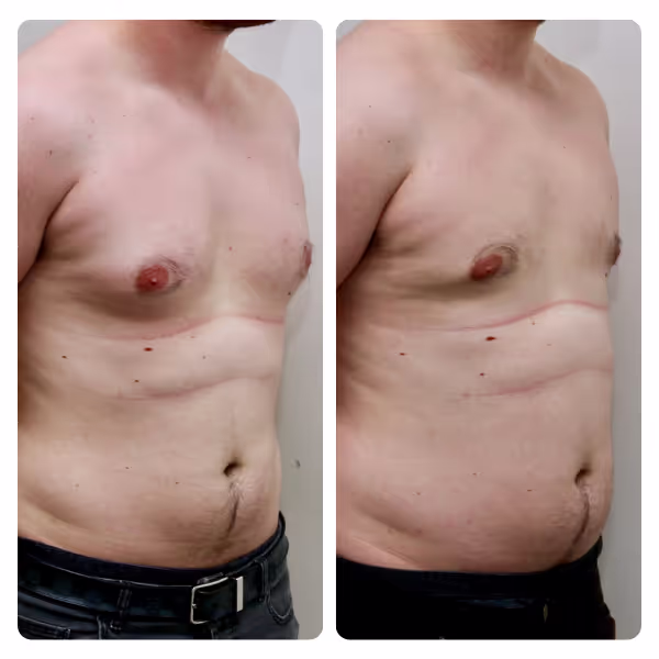 Gynecomastia Surgery in Turkey
